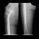 Periarticular ossifications after replacement of hip joint, pseudoarthrosis, false joint: X-ray - Plain radiograph